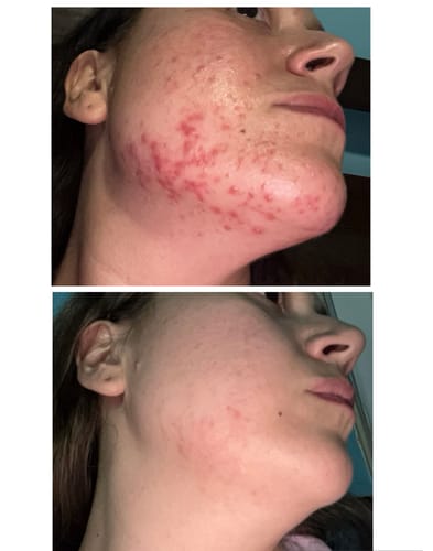 Customer photo review of BeautyPro 2.0 - High Frequency Wand