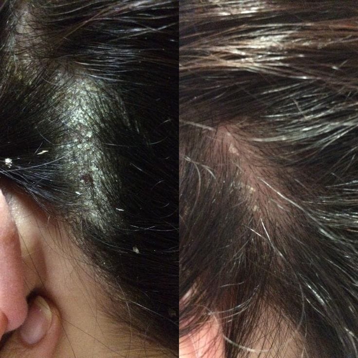 Customer photo review of Pack Caspa Seca y Psoriasis: Shampoo Detox Hidratante en barra + Tónico Calmante 100 ml | Para caspa seca, picazón o brotes