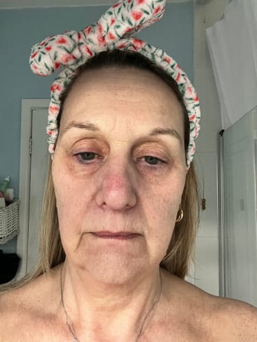 Customer photo review of 5-Step Clear Skin Kit