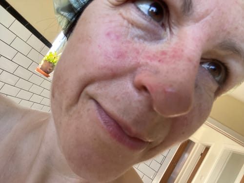 Customer photo review of 5-Step Clear Skin Kit