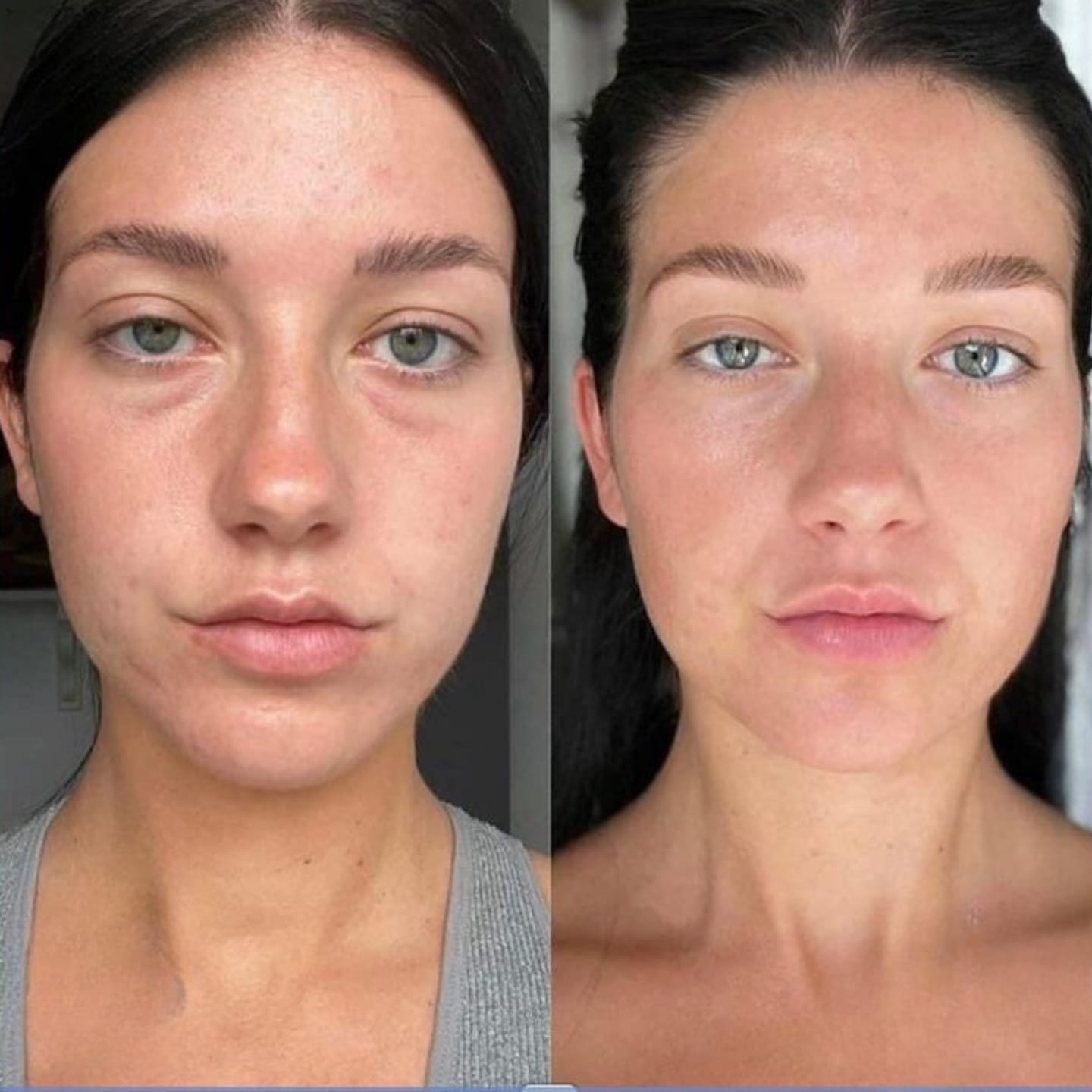 Customer photo review of Hyaluron Gesichtsmaske