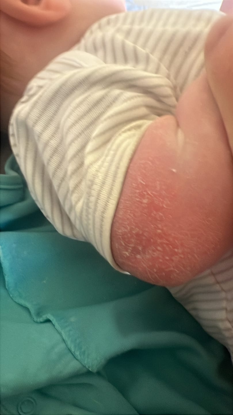 Customer photo review of Bioskin Junior Outbreak Rescue Cream