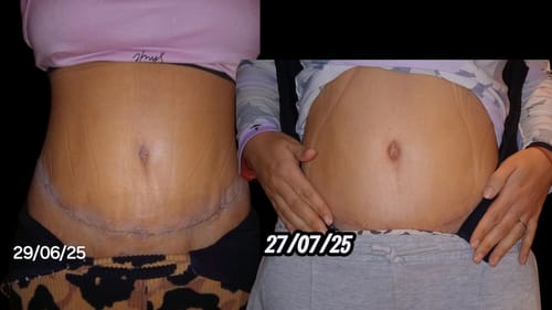 Customer photo review of Crema AntiEstrías🧴🦵 - 200ml EMILY