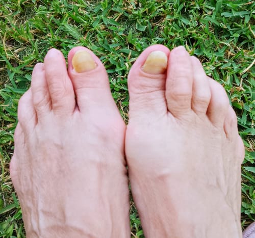 Customer photo review of Pentachom SE Antifungal Laser Program