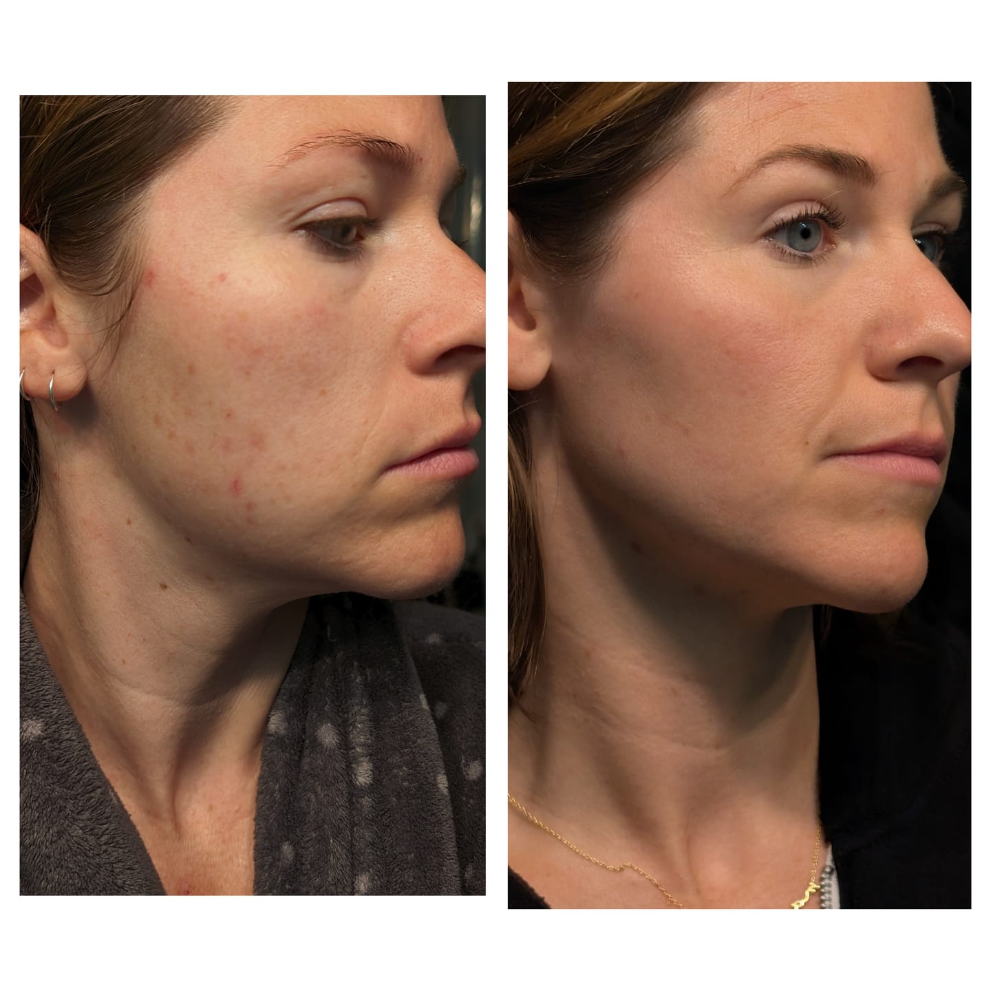 Customer photo review of The Complete Acne System for Women
