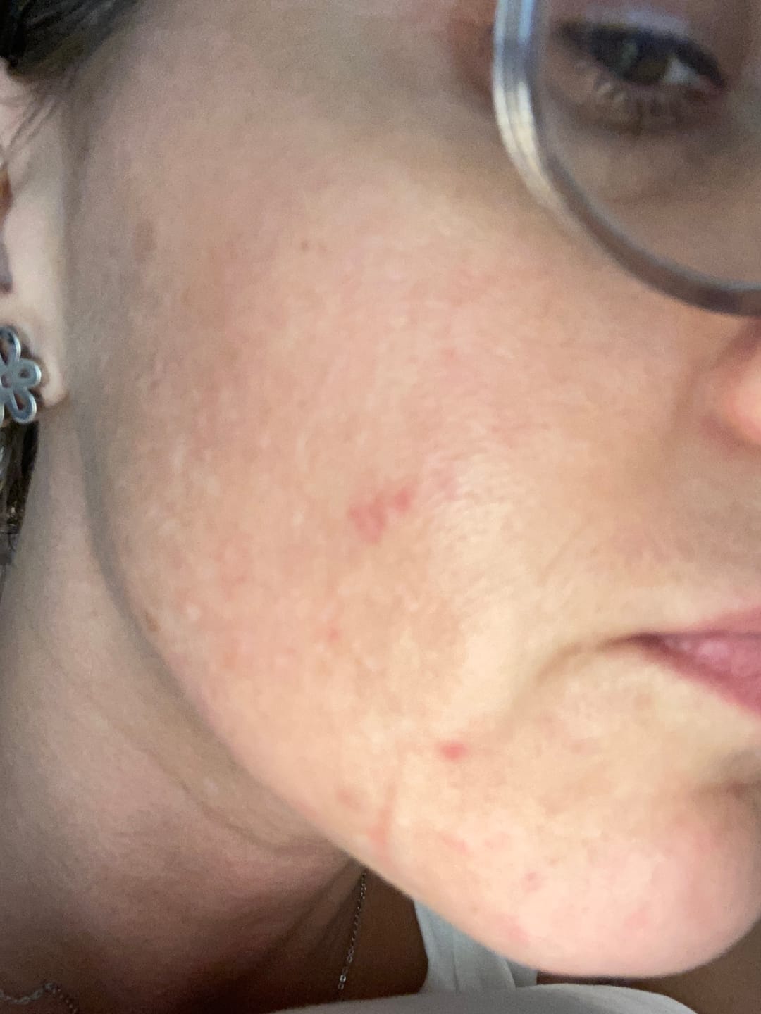 Customer photo review of Instant Rosacea, Acne & Redness Stopper