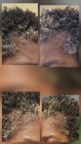 Customer photo review of VIRAL "EXTREME STRENGTH" Hair Growth Serum -
