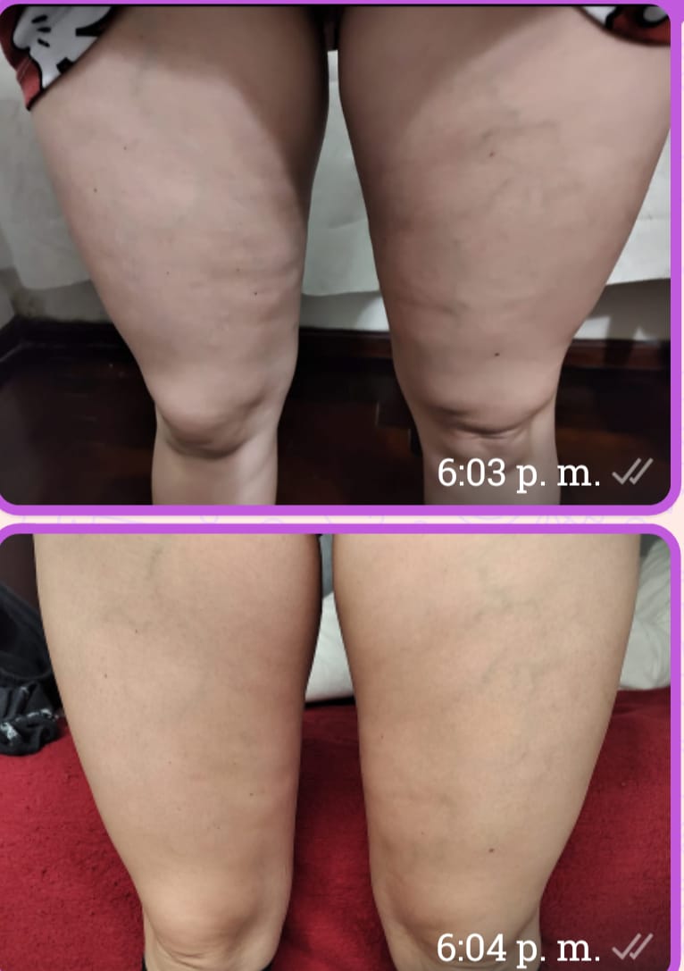 Customer photo review of Crema AntiCelulitis🧴🦵 - 200ml EMILY