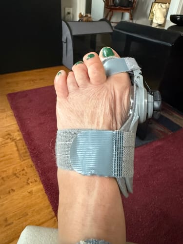 Customer photo review of Treatmedy™ Bunion Fix - Natural At-Home Bunion Relief