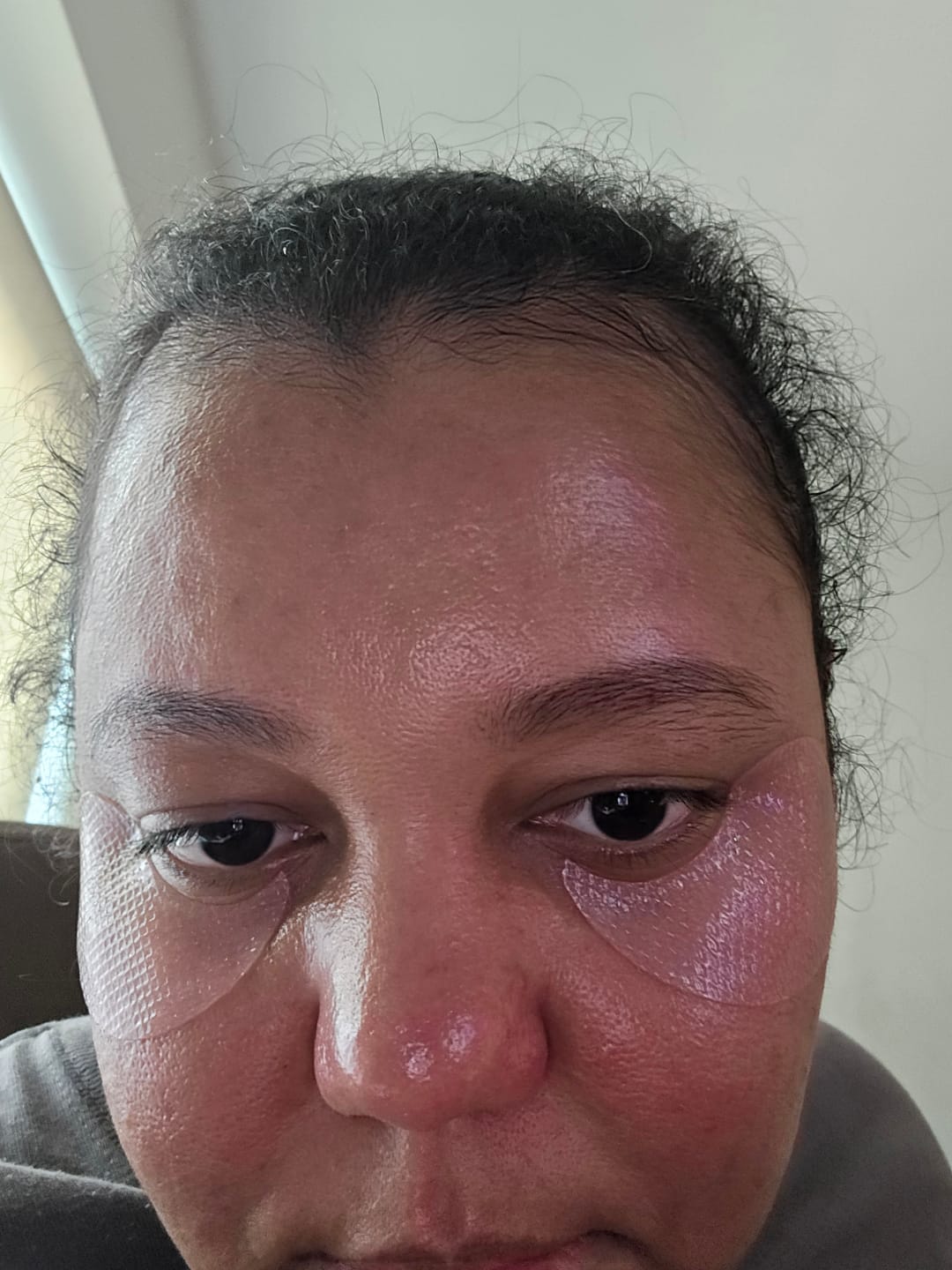 Customer photo review of PDRN retinal eye patch Glow jelly