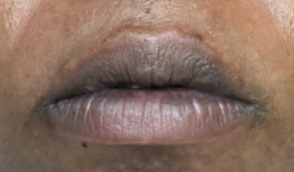 Customer photo review of Lips Lightening Cream For Men and Women (Results in 5 Days or Less)