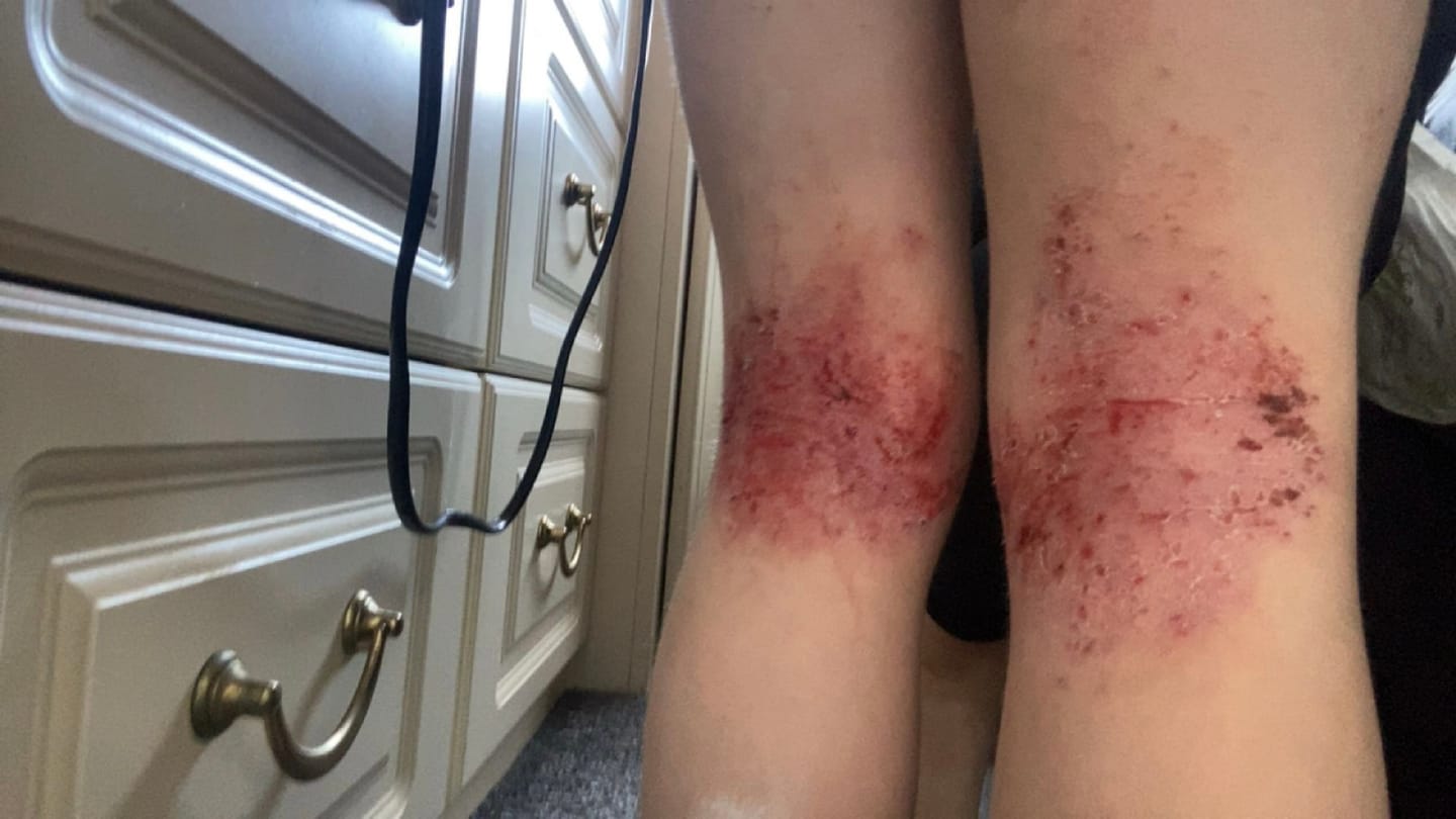 Customer photo review of Bioskin Junior Duo Pack