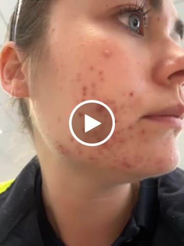 Customer video review of Intermediate Acne Program™