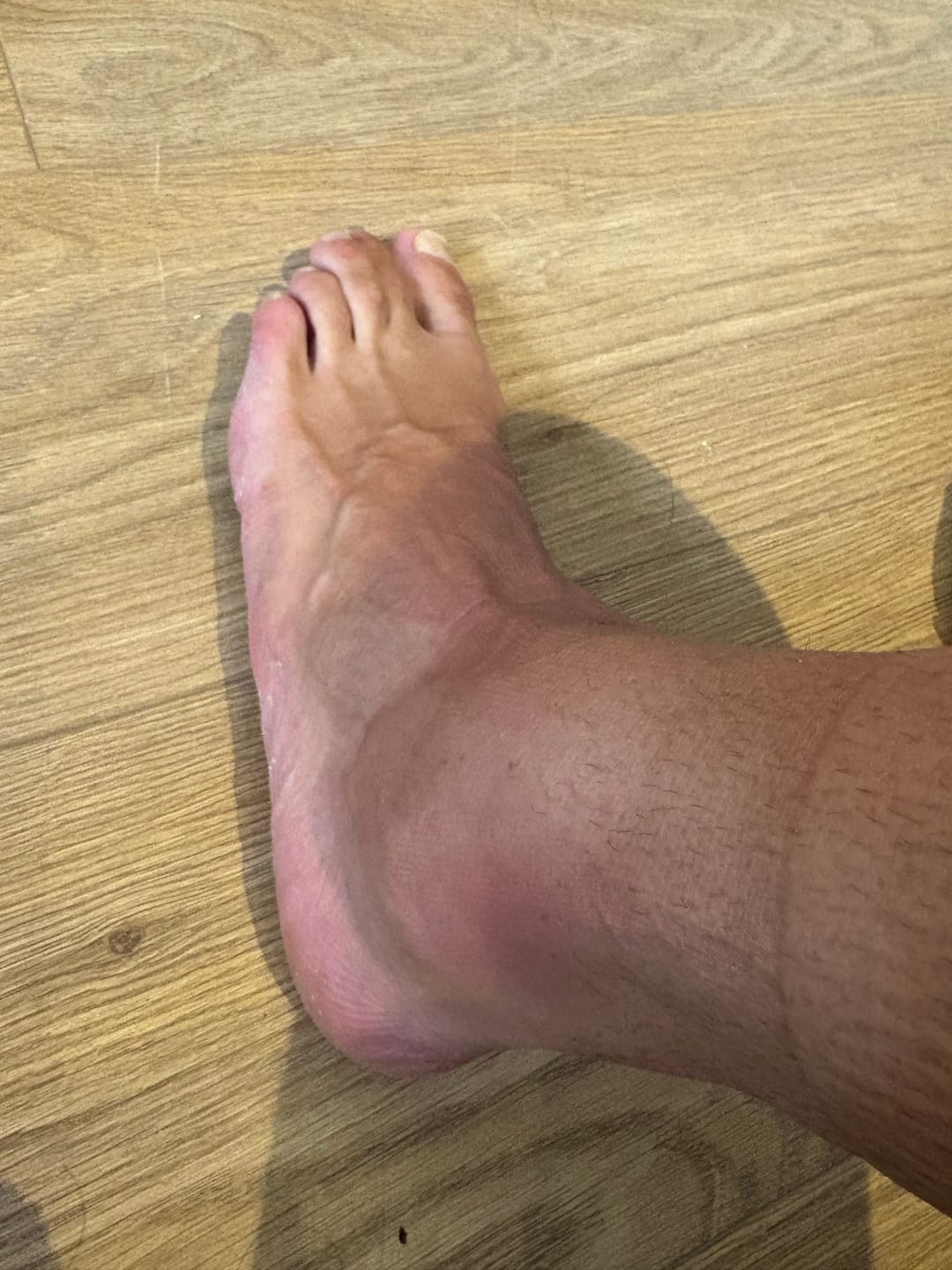 Customer photo review of Pair of Ankle Compression Support Sleeves For Achilles Tendon and Ankle Sprains
