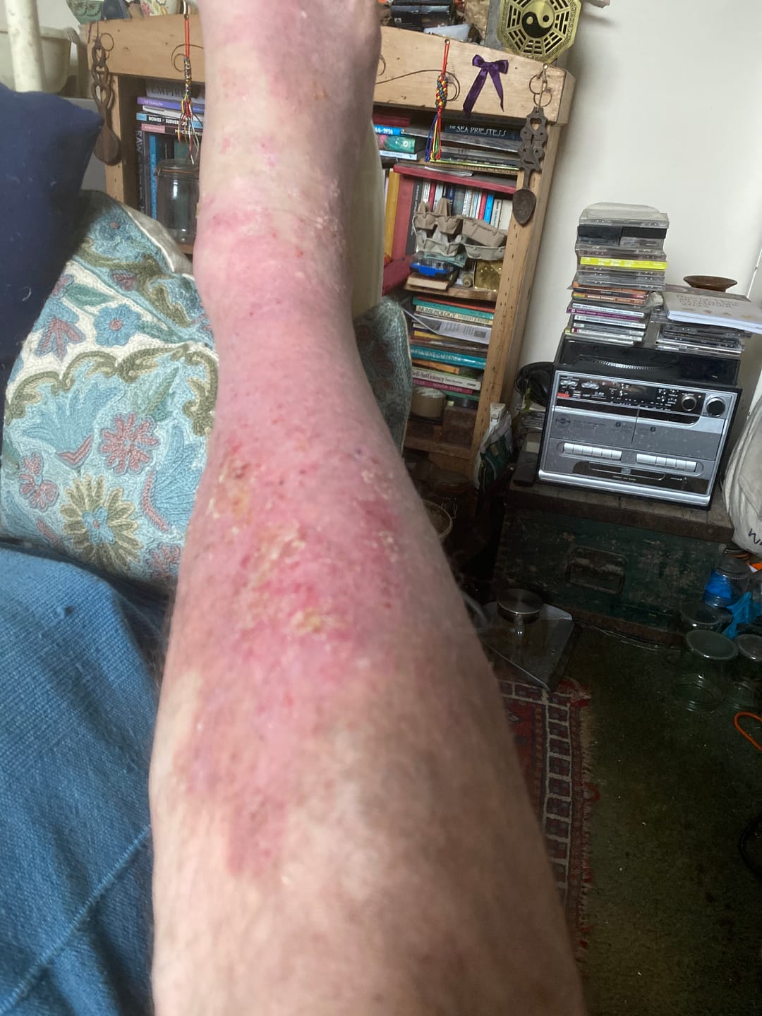 Customer photo review of Bioskin Zeoderm Skin Repair Moisturiser