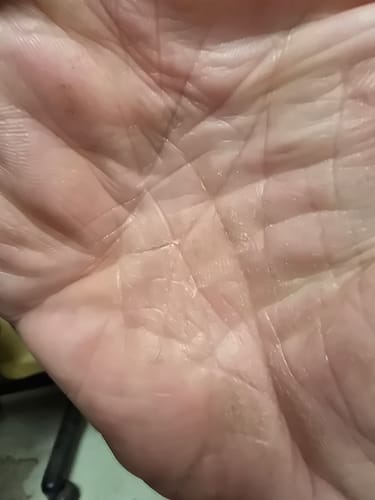 Customer photo review of SERENI Pikkelysömör és Ekcéma Krém
