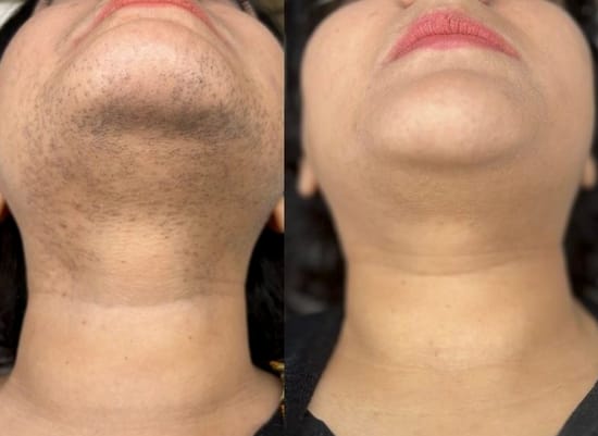 Customer photo review of Instant Hair Removal Kit
