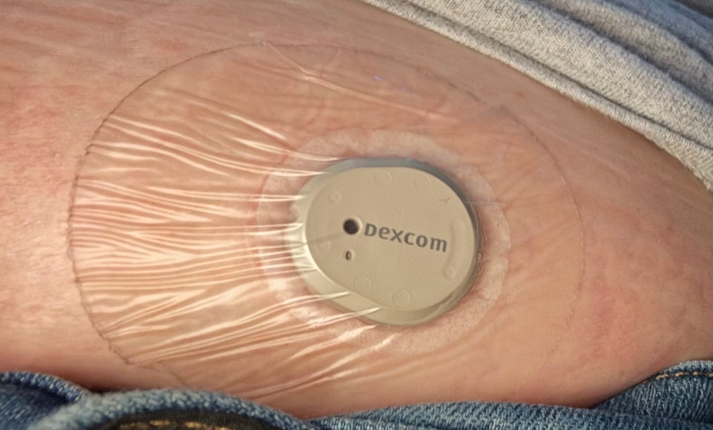 Customer photo review of Skin Grip Original - Dexcom G7 & Stelo Adhesive Patches
