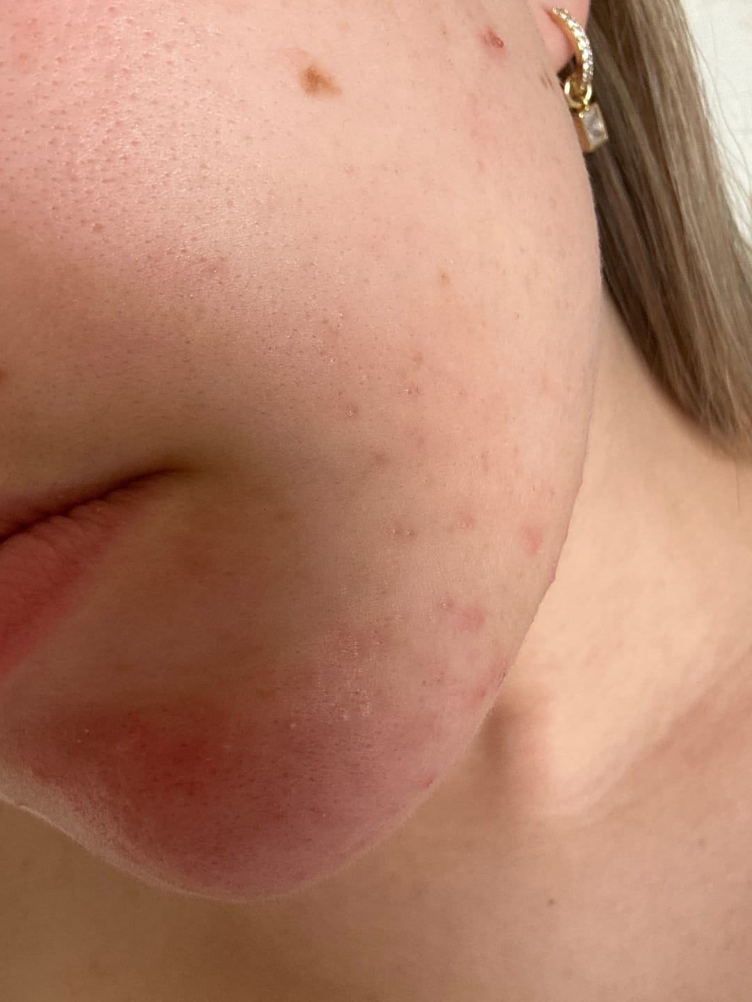 Customer photo review of Antiac Acne Rescue Pack