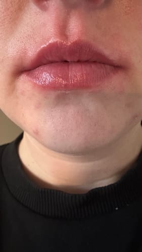 Customer photo review of COSTIQ® EXTREME LIP PLUMPER