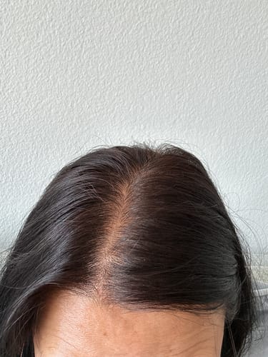 Customer photo review of Nutrafol Women's Balance Hair Growth Supplements