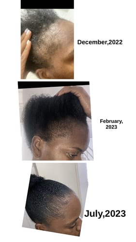 Customer photo review of Hair Recovery Bundle
