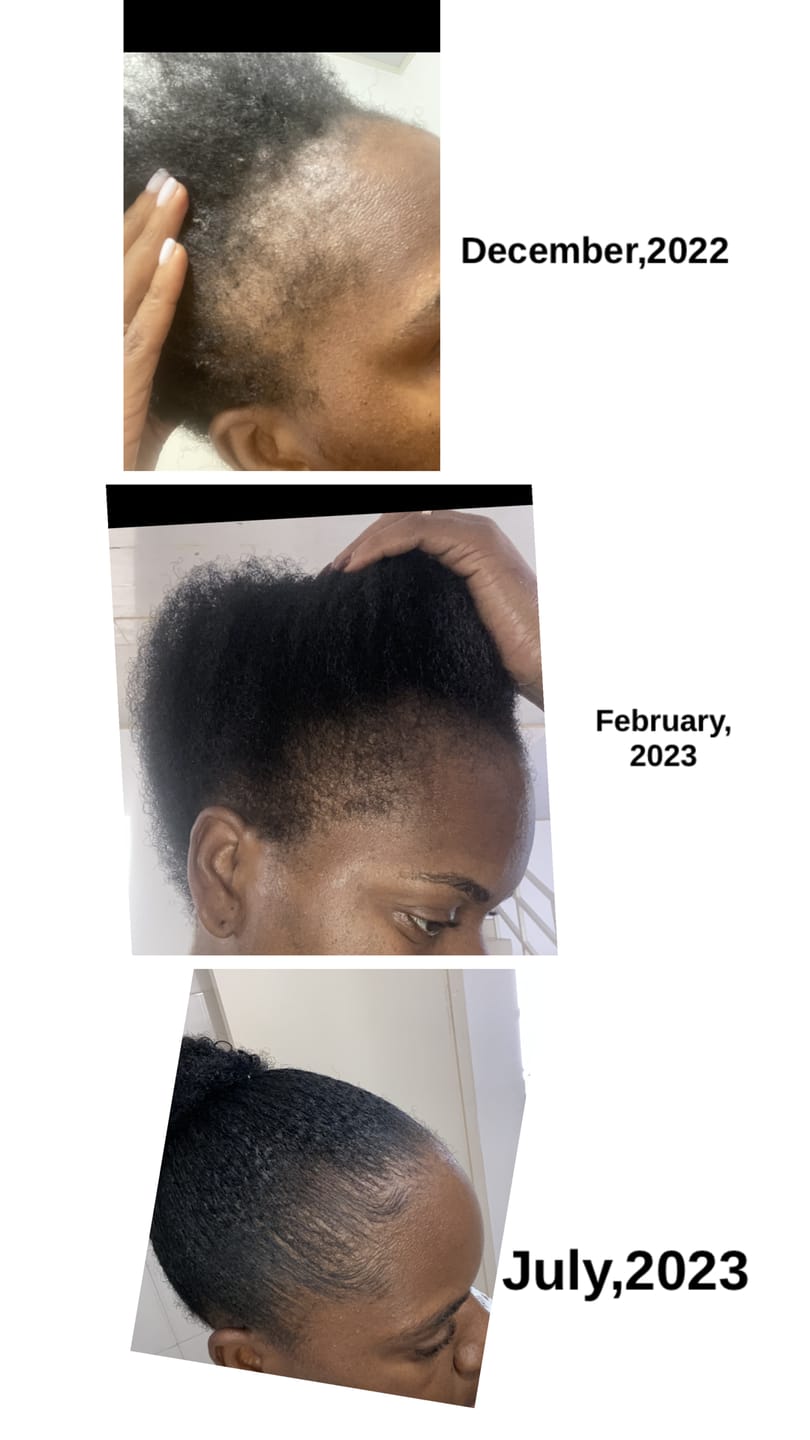 Customer photo review of Hair Recovery Bundle