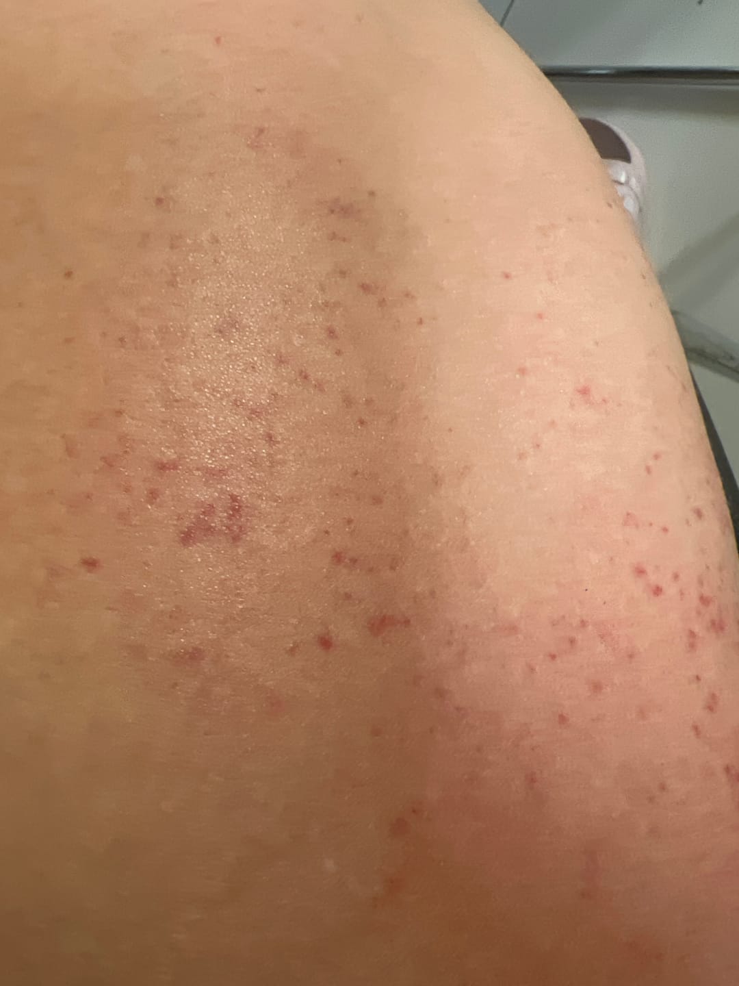 Customer photo review of Revimus Anti-Cellulite Massager