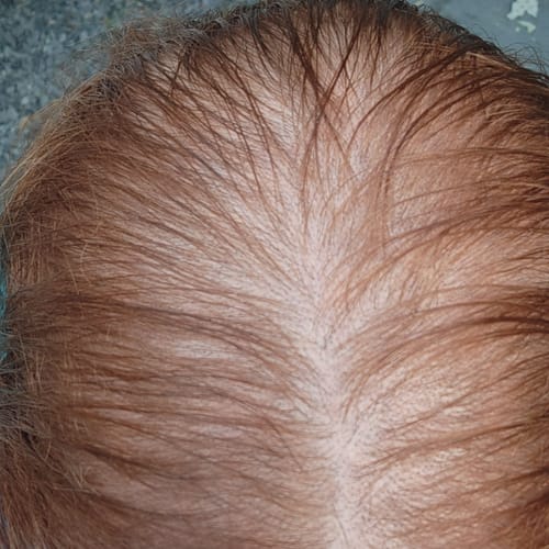 Customer photo review of Glov Hair Regrowth System