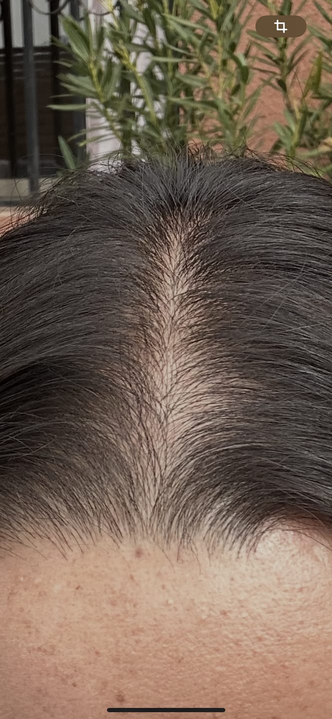 Customer photo review of Pack Anticaída de Cabello para 1 Mes