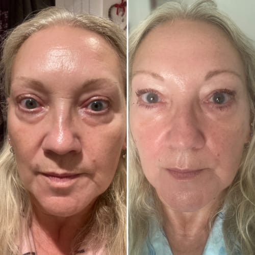 Customer photo review of 5-Step Clear Skin Kit