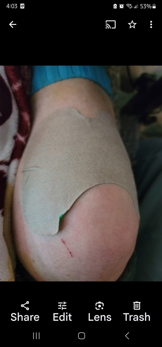 Customer photo review of Auxillium Knee Patch (fka Heaven Patch)