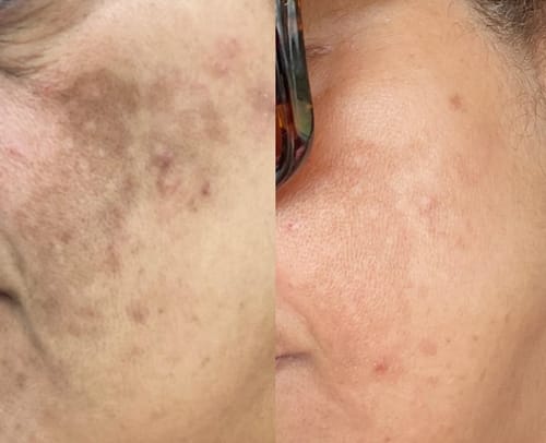 Customer photo review of Skin Fit Re-Brighten 5 Pack Micro/NanoNeedling Ampoules