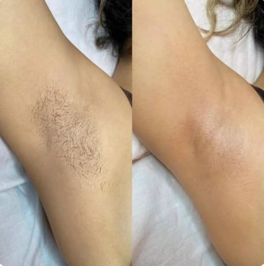 Customer photo review of IPL Haarentfernungsgerät für dauerhafte, schmerzfreie Ergebnisse