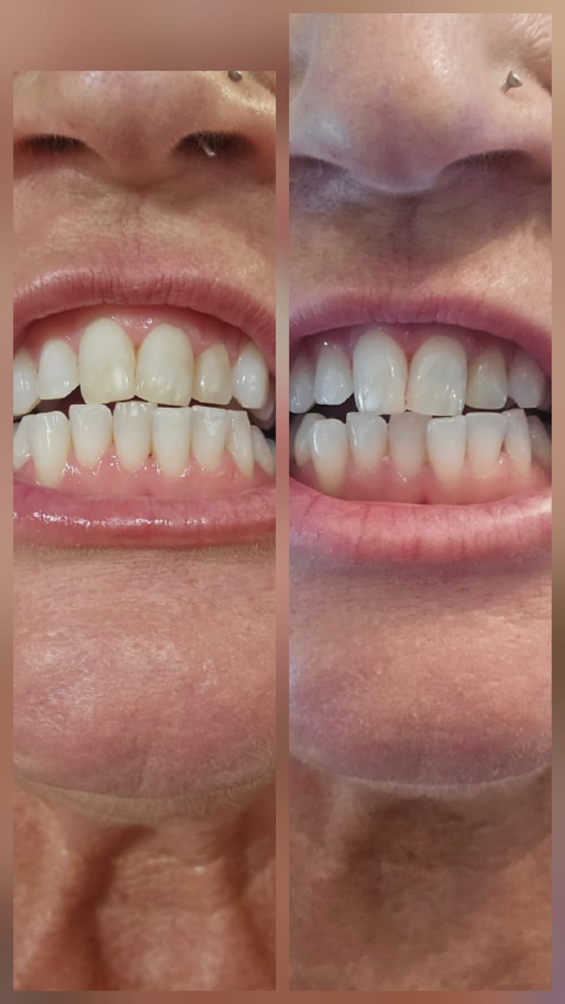 Customer photo review of Teeth Whitening Strips