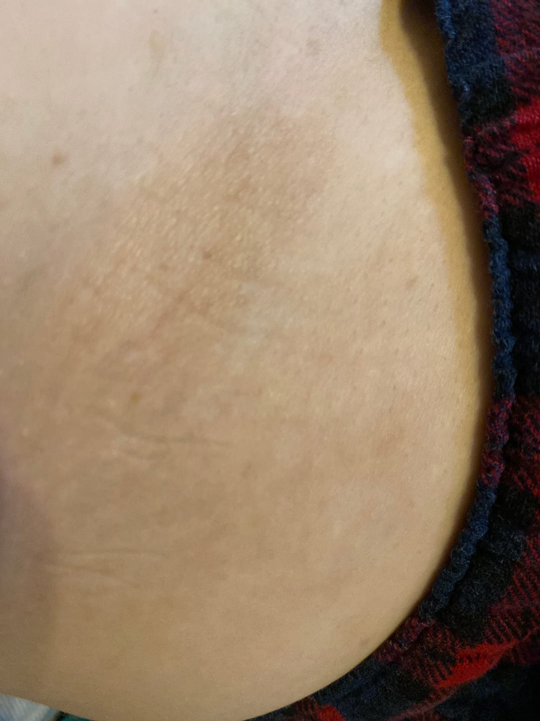Customer photo review of Bioskin Zeoderm Skin Repair Moisturiser