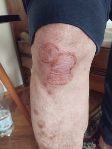 Customer photo review of SERENI Pikkelysömör és Ekcéma Krém
