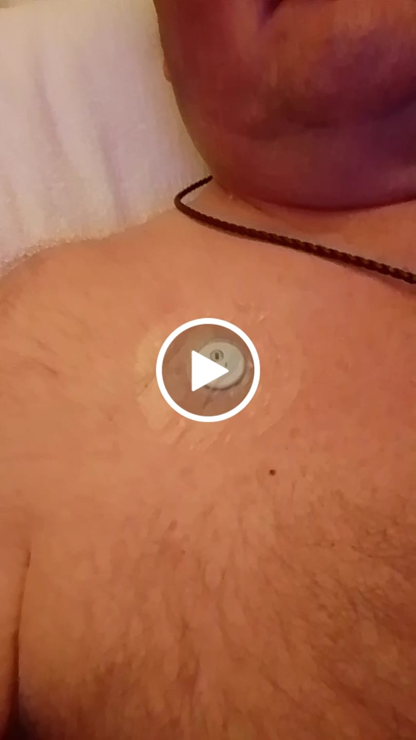 Customer video review of Transparent CGM Patch för Freestyle Libre 1, 2 & 3