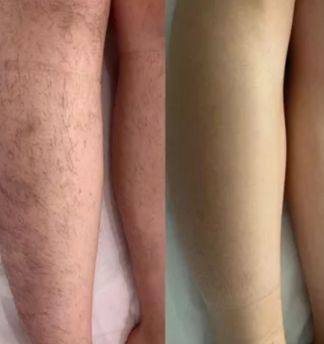 Customer photo review of Épilation Définitive Professionnelle à la Lumière Pulsée IPL™