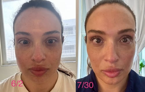 Customer photo review of JawlineFix: Masseter Botox