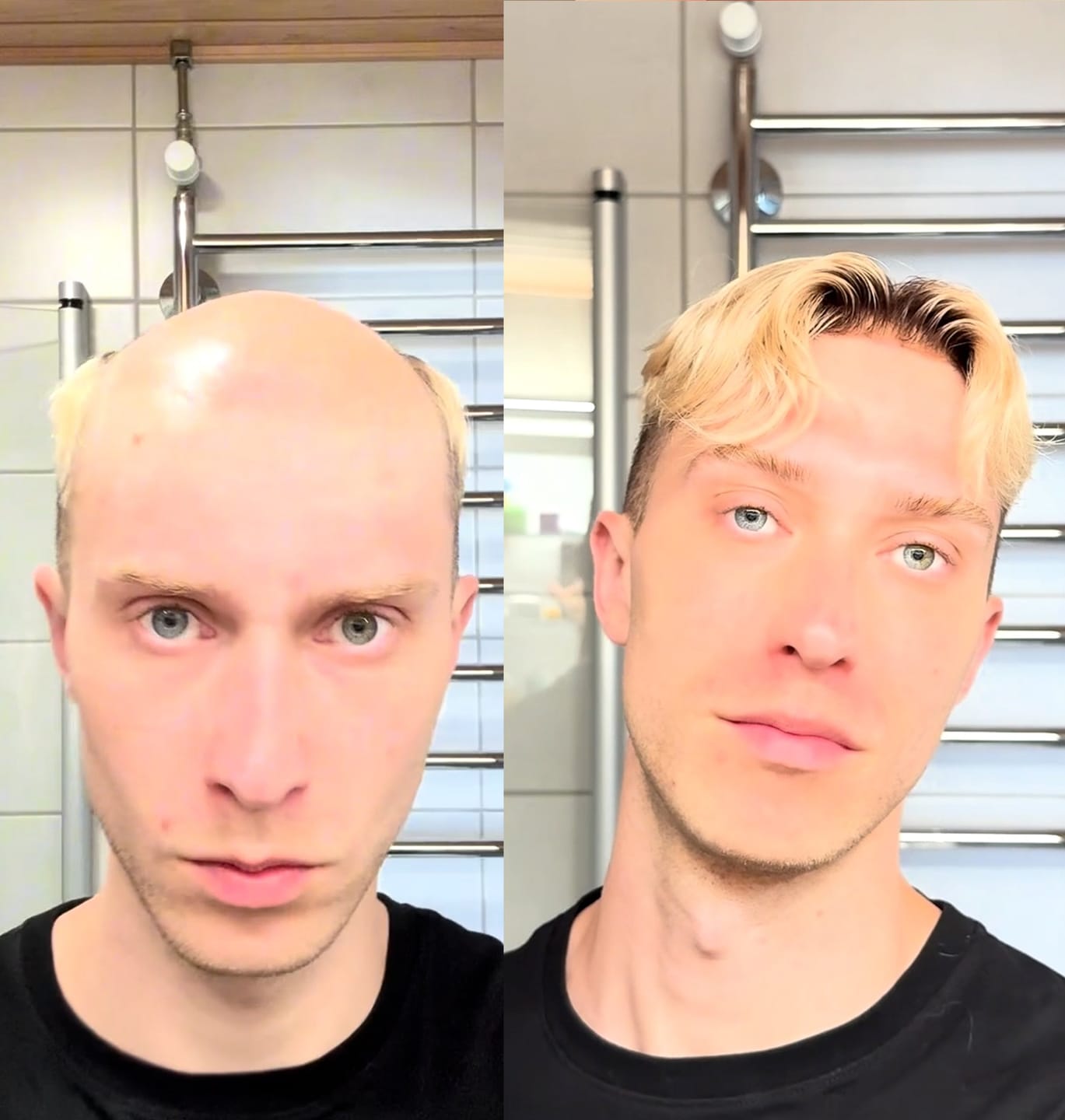 Customer photo review of Men Hair Pieces Victor|V-loop 0608mm Ultra-thin skin base