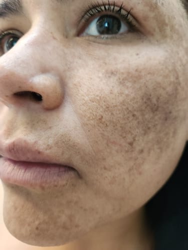 Customer photo review of INIA LUMIN Eye Skincare Device