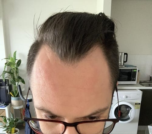 Customer hairline