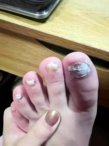 Customer photo review of NUVEX Multi-Nail LED Anti-Fungus Kit