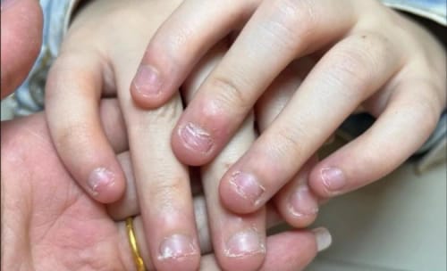 Customer photo review of NUVEX-Multi-Nail LED Anti-Fungus Kit