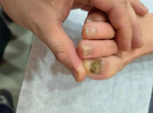 Customer photo review of NUVEX Multi-Nail LED Anti-Fungus Kit