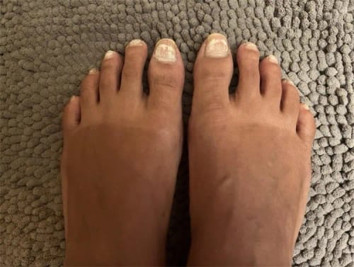 Customer photo review of NUVEX Multi-Nail LED Anti-Fungus Kit