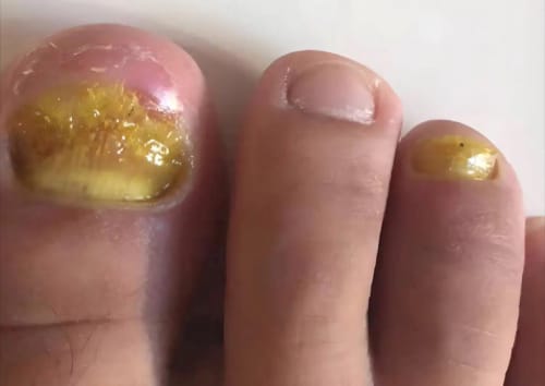 Customer photo review of NUVEX-Multi-Nail LED Anti-Fungus Kit