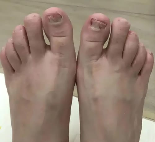 Customer photo review of NUVEX-Multi-Nail LED Anti-Fungus Kit