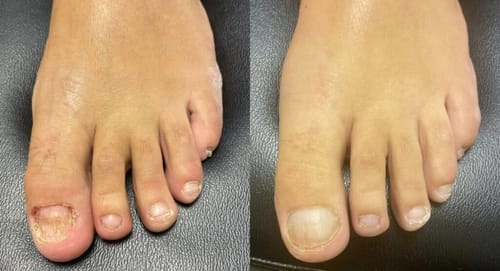 Customer photo review of NUVEX-Multi-Nail LED Anti-Fungus Kit